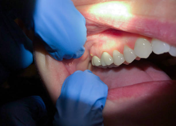 Best Broken Tooth Emergency  in Smithville Sanders, IN